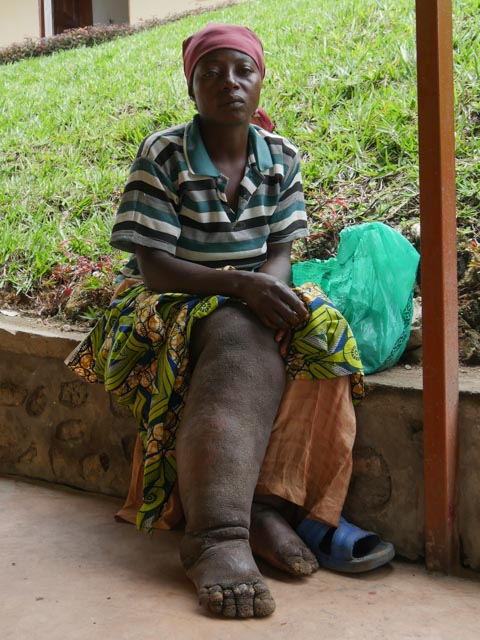 Elephantiasis patient Fatuma Kabilambali